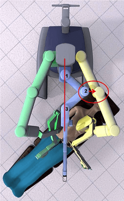 Single site Robotic Surgery